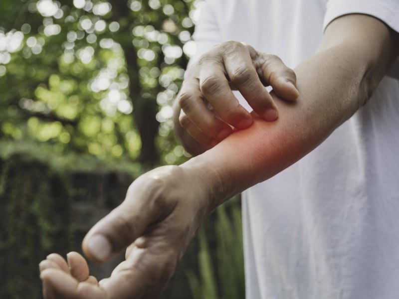 krätze duisburg.jpg